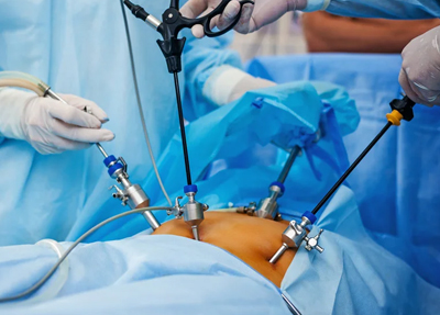Laparoscopic Surgery